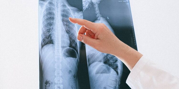 ¿Cuáles son los principales síntomas del cáncer de pulmón? Recuerda que la detección temprana salva vidas