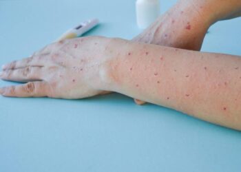 Guanajuato cierra la emergencia internacional de viruela del mono con 22 casos confirmados