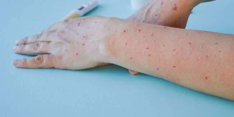 Guanajuato cierra la emergencia internacional de viruela del mono con 22 casos confirmados