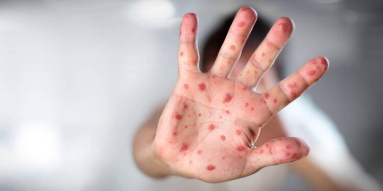 Guanajuato se mantiene sin casos documentados de sarampión