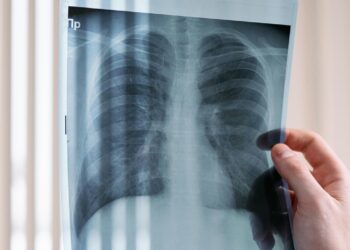 Hoy es el Día Mundial de la Tuberculosis; ¿cómo diagnosticar esta enfermedad?