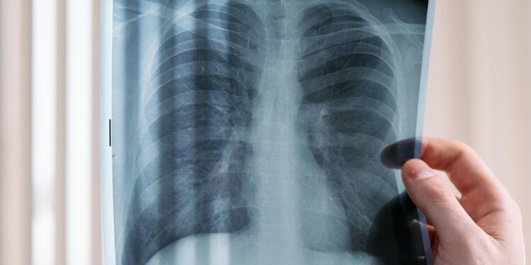 Hoy es el Día Mundial de la Tuberculosis; ¿cómo diagnosticar esta enfermedad?