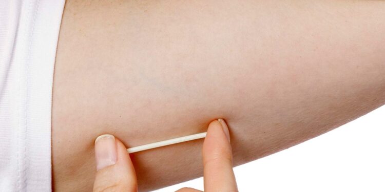 ¿Buscas un método anticonceptivo? En Valle de Santiago aplicarán gratuitamente implantes subdérmicos a mujeres