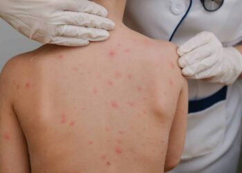 ¿Cómo reforzar desde casa las medidas preventivas contra el sarampión?