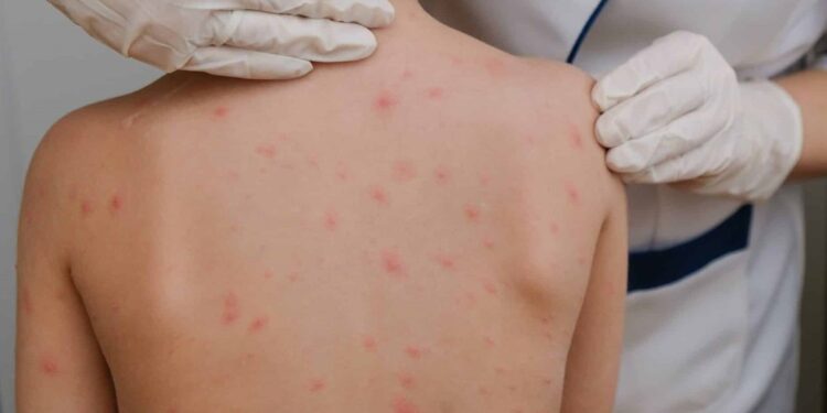 ¿Cómo reforzar desde casa las medidas preventivas contra el sarampión?